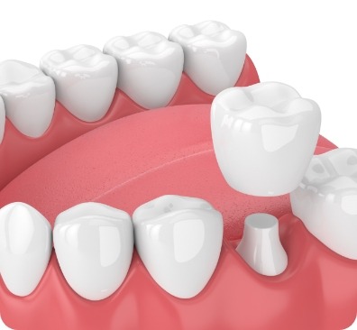 NE Calgary Dental Crown and Dental Bridge | Monterey Dental Centre | NE Calgary Dentist