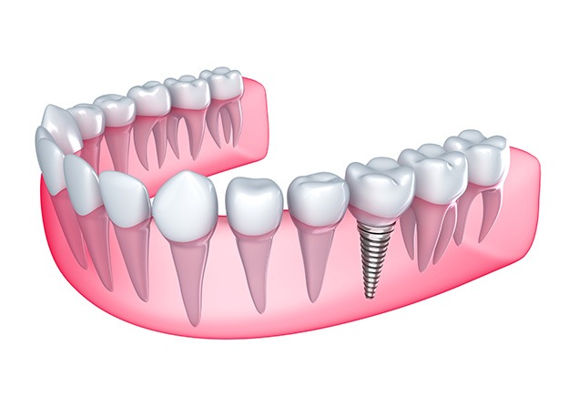 NE Calgary Dental Implants | Monterey Dental Centre | NE Calgary Dentist