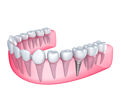 NE Calgary Dental Implants | Monterey Dental Centre | NE Calgary Dentist