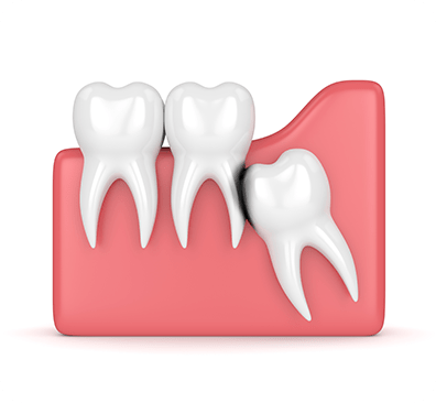 NE Calgary Teeth Extractions | Monterey Dental Centre | NE Calgary Dentist