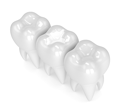 NE Calgary Dental Fillings | Monterey Dental Centre | NE Calgary Dentist