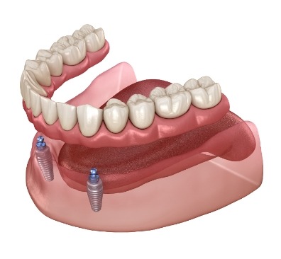 NE Calgary Implant Retained Dentures | Monterey Dental Centre | NE Calgary Dentist
