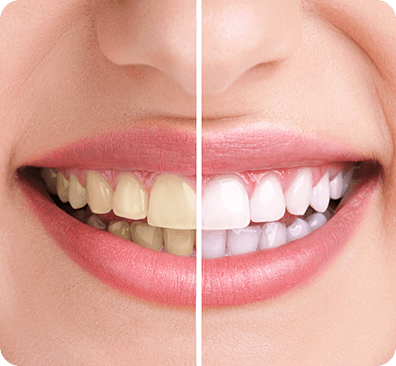 NE Calgary Teeth Whitening Before and After | Monterey Dental Centre | NE Calgary Dentist