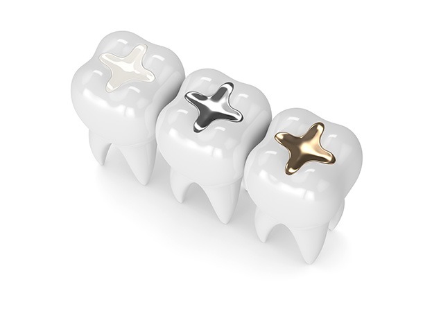 NE Calgary Tooth Fillings | Monterey Dental Centre | NE Calgary Dentist