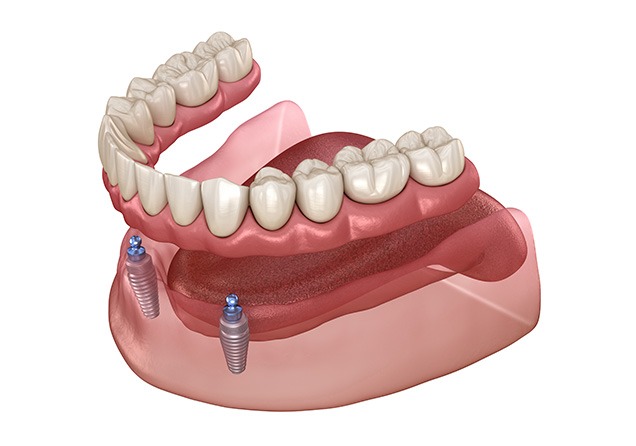 NE Calgary Implant Dentures | Monterey Dental Centre | NE Calgary Dentist