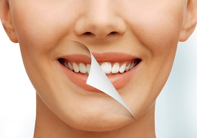 NE Calgary Teeth Whitening | Monterey Dental Centre | NE Calgary Dentist